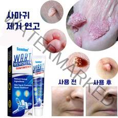 [당일배송] 사마귀치료 사마귀제거제 얼굴 사마귀 물사마귀 쥐젖제거크림, 1, 1개